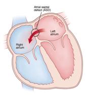 Description: Front view cross section of upper heart showing right and left atria. Closing device is in septum between atria.